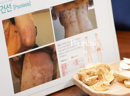 생기한의원으로 보는 건선 피부 긁지 않아야 하는 이유